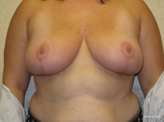 Breast Reduction: Patient 2 - After  