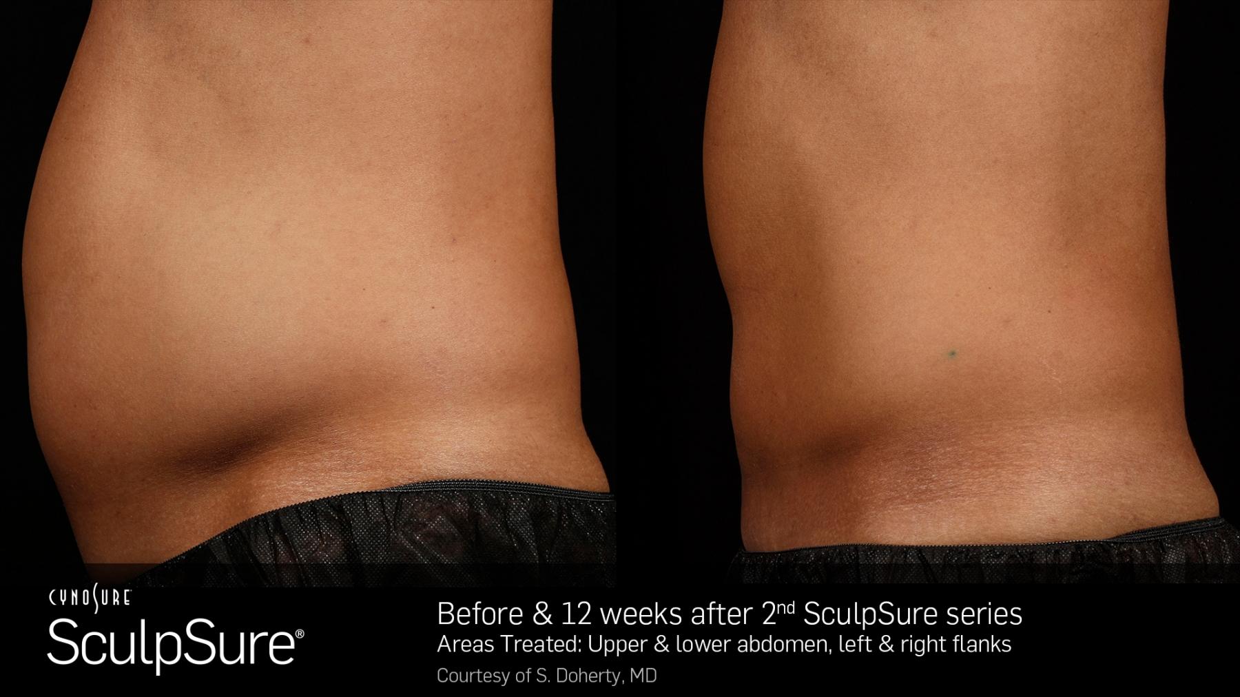 SculpSure™: Patient 6 - Before and After  