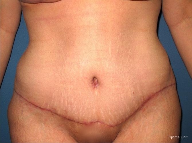 Abdominoplasty: Patient 1 - After  