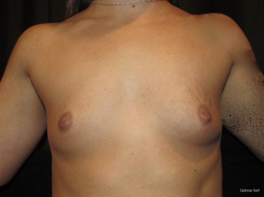 Breast Augmentation: Patient 9 - Before 