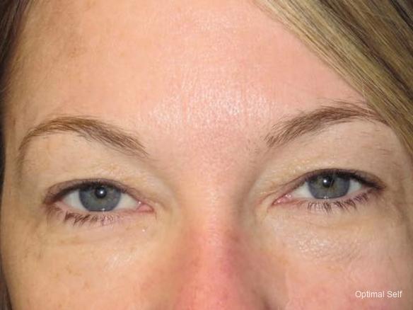 Eyelid Lift: Patient 3 - Before 