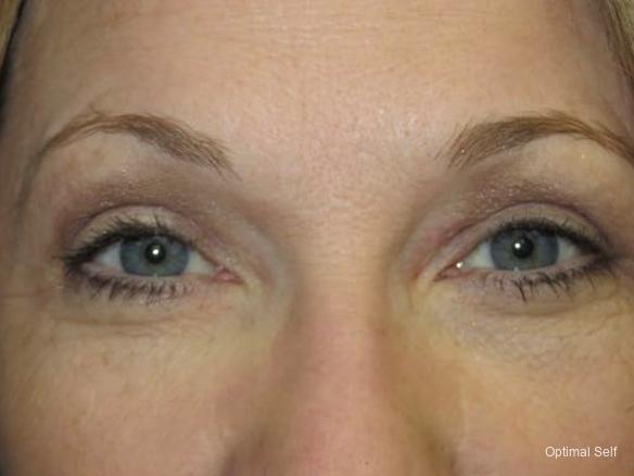 Eyelid Lift: Patient 3 - After  