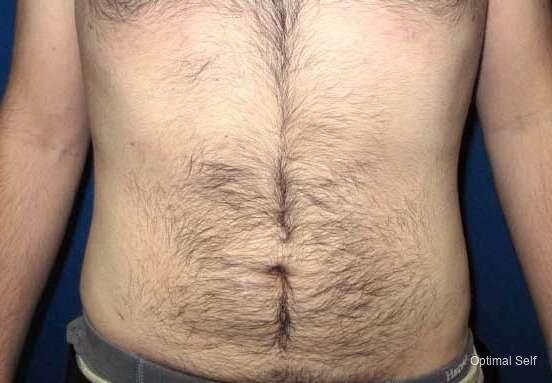 Liposuction: Patient 1 - After  