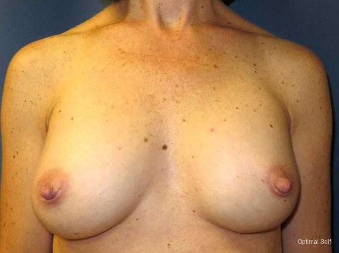 Breast Augmentation: Patient 3 - After  