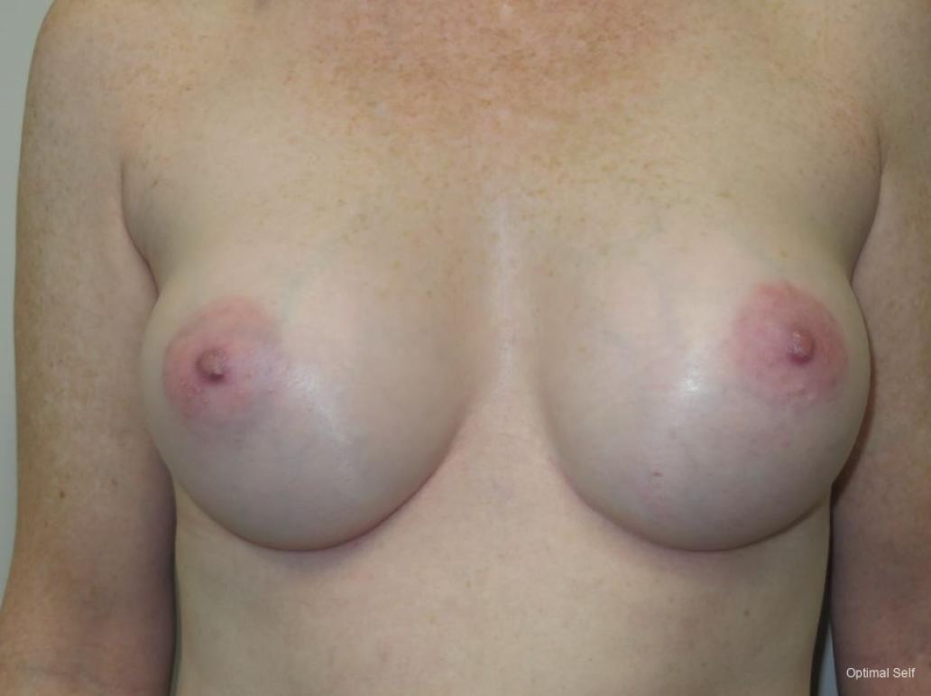 Breast Augmentation: Patient 6 - After 1