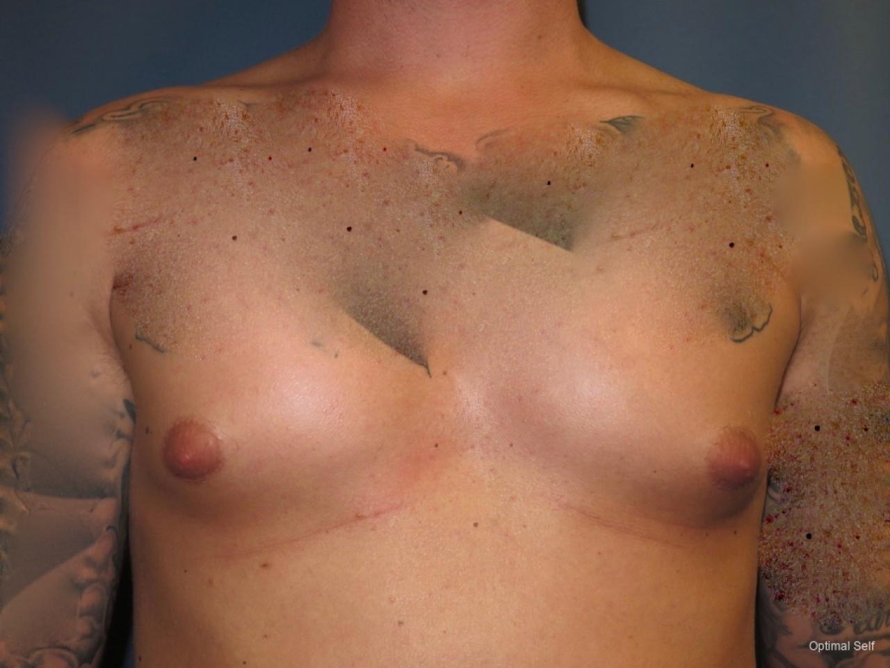 Gynecomastia: Patient 2 - After  