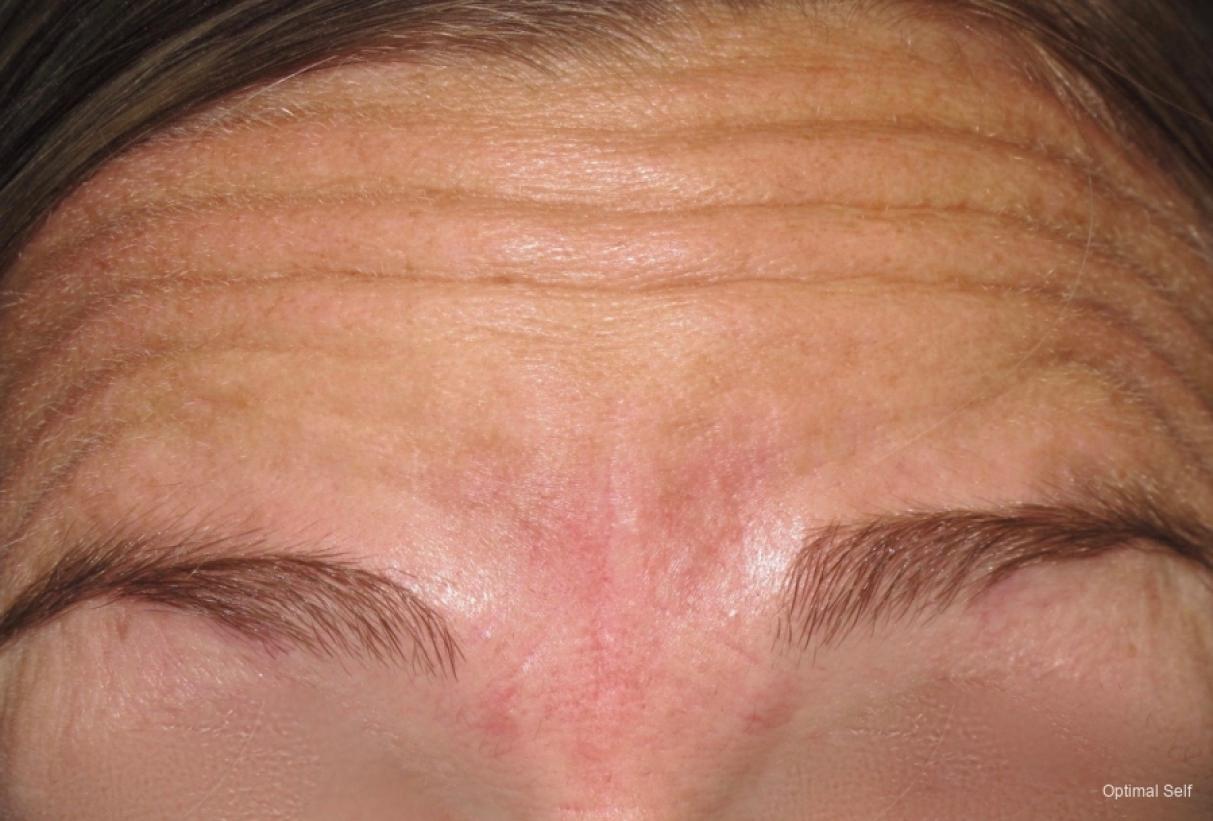 BOTOX® Cosmetic: Patient 2 - Before 