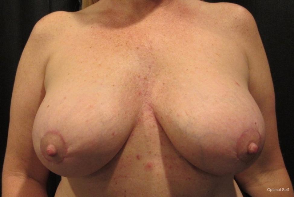 Breast Unclassified: Patient 1 - After  