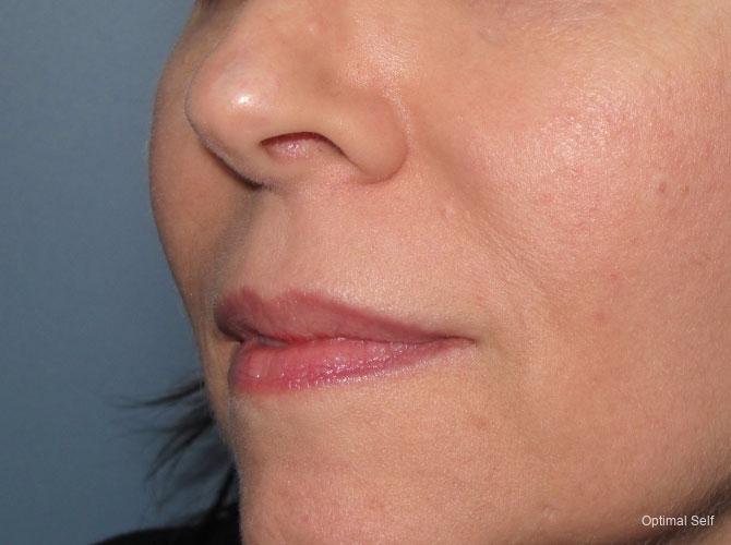 Juvederm: Patient 2 - After  