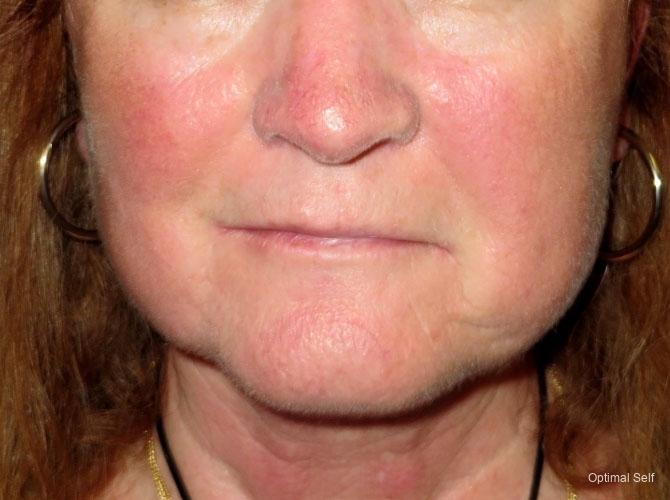 Facelift: Patient 1 - After  