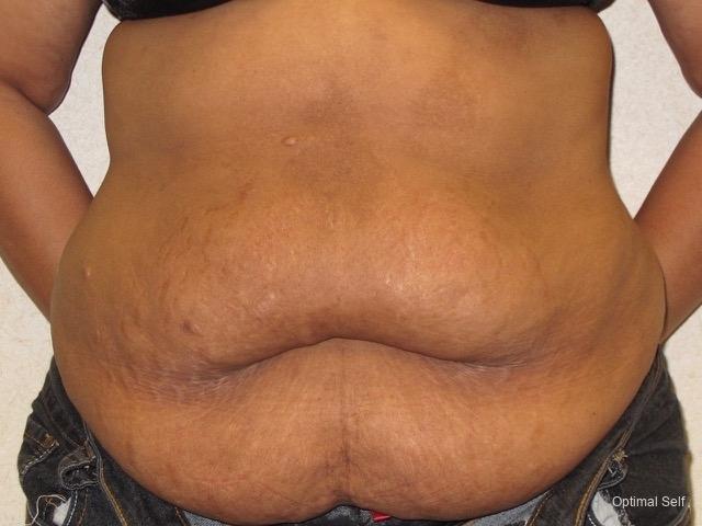 Tummy Tuck: Patient 1 - Before 