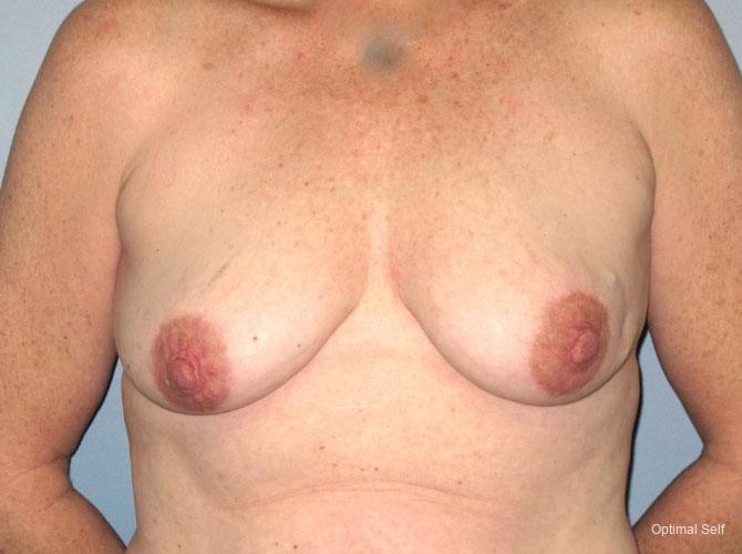 Breast Reconstruction: Patient 3 - Before 