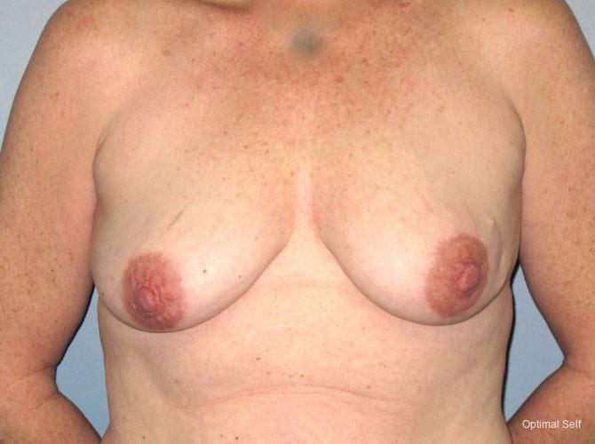 Breast Reconstruction: Patient 3 - After  