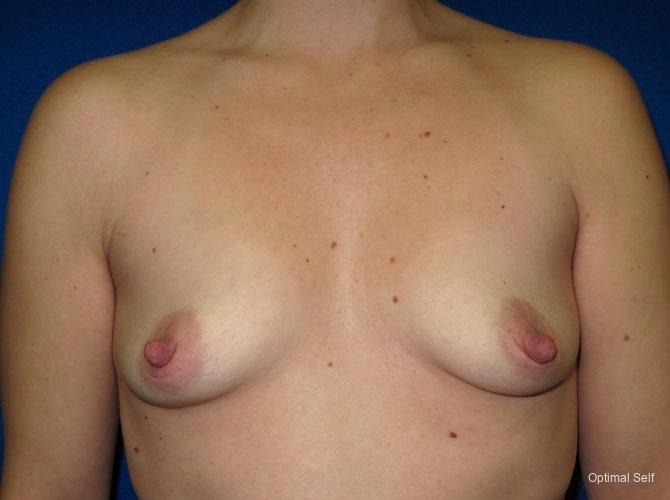 Breast Augmentation: Patient 2 - Before 