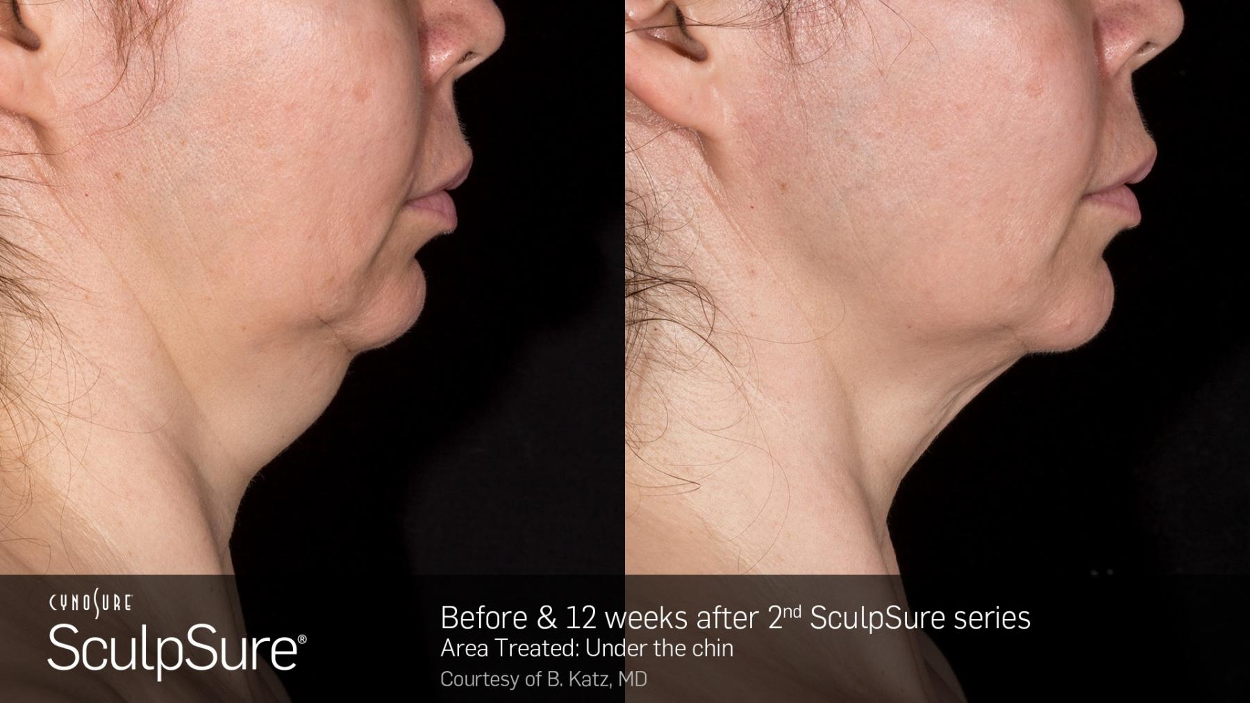 SculpSure™: Patient 7 - Before and After  