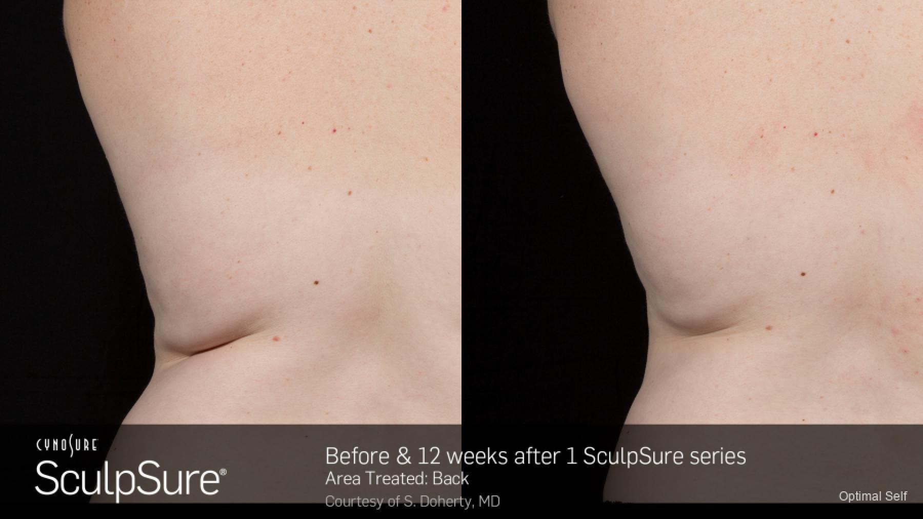 SculpSure™: Patient 1 - Before and After  