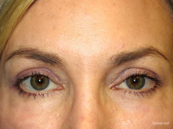 Eyelid Lift: Patient 2 - After  