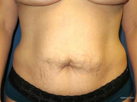 Abdominoplasty: Patient 1 - Before 