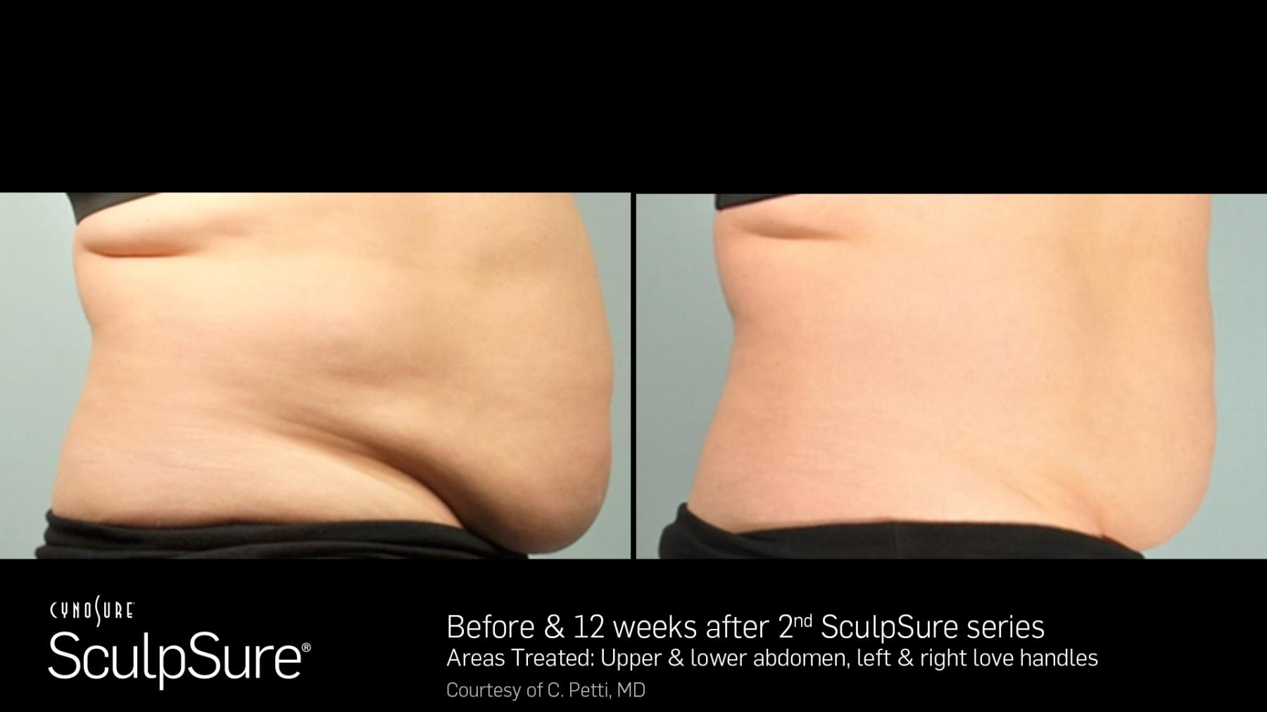 SculpSure™: Patient 5 - Before and After  