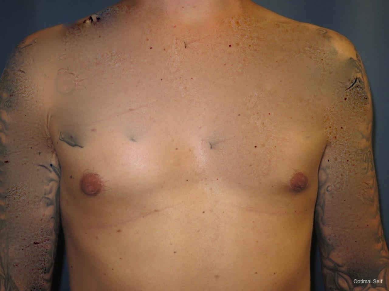 Gynecomastia: Patient 3 - After  