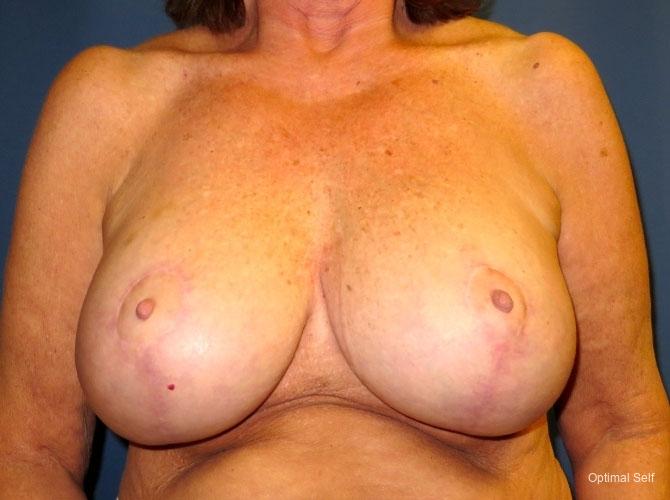 Breast Lift: Patient 3 - After  
