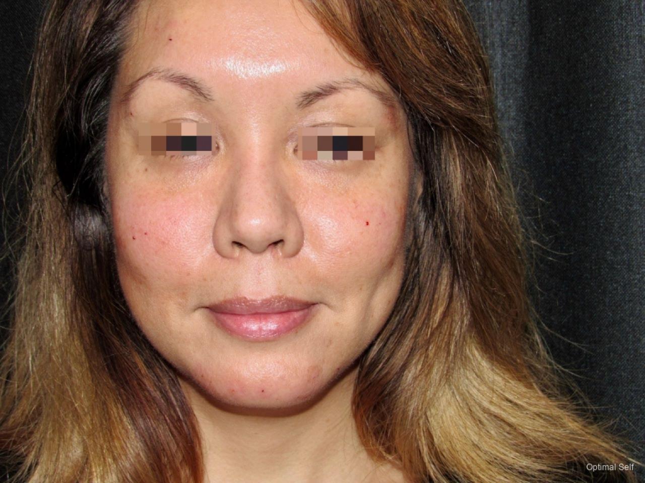 Juvederm: Patient 3 - After  