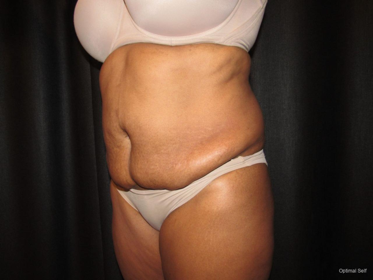 Abdominoplasty: Patient 6 - Before and After 2