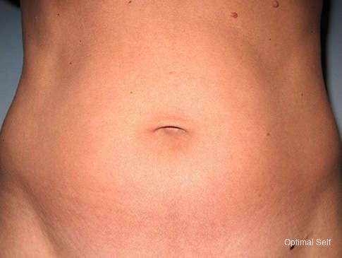 Liposuction: Patient 3 - After  