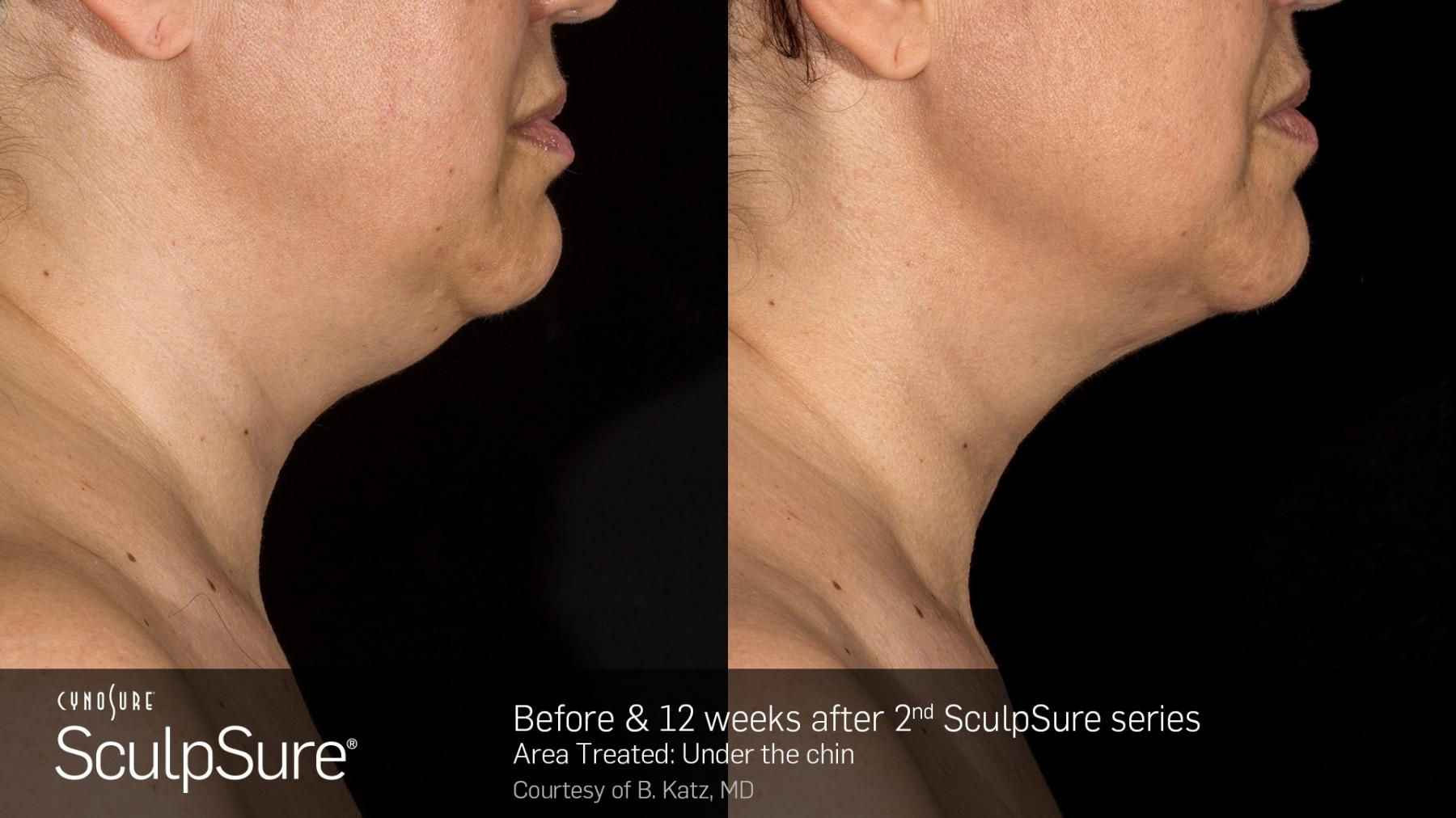 SculpSure™: Patient 3 - Before and After  