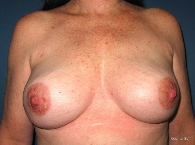 Breast Reconstruction: Patient 3 - After  