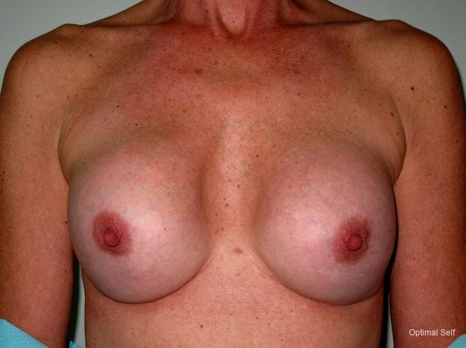 Breast Revision: Patient 2 - Before 
