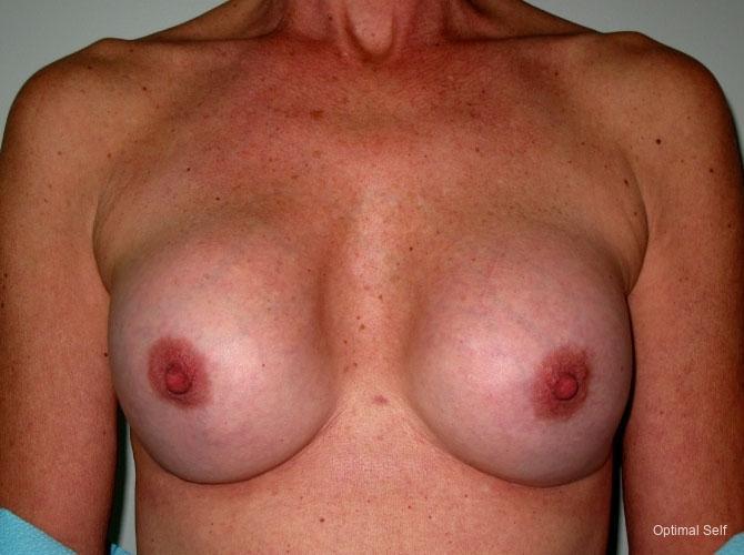 Breast Revision: Patient 2 - After  