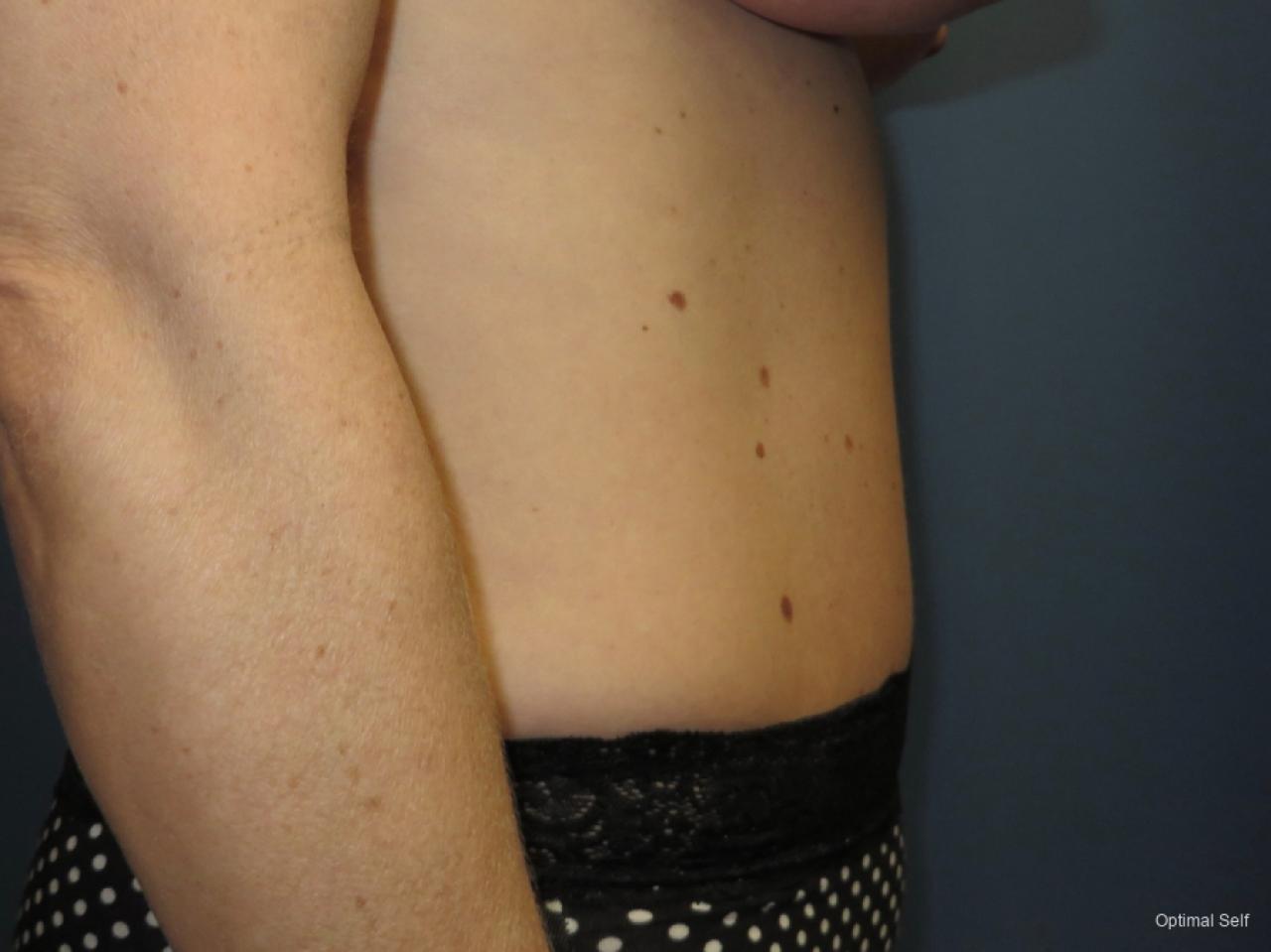 Abdominoplasty: Patient 4 - After 2