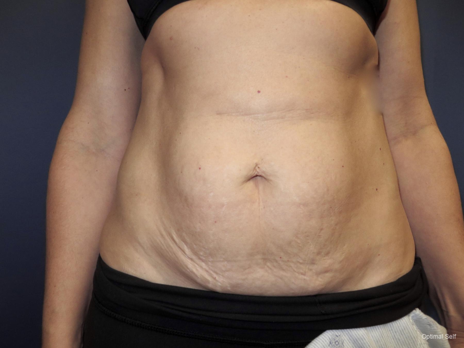 Abdominoplasty: Patient 2 - After  