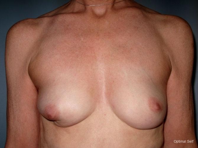 Breast Reconstruction: Patient 4 - Before 