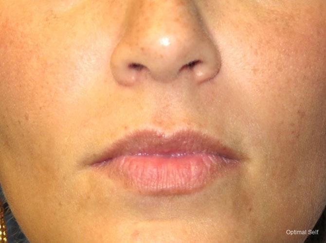 Juvederm: Patient 1 - After  