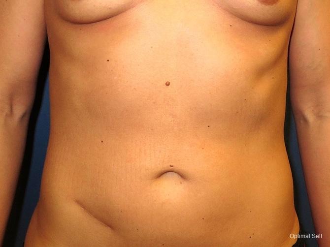 Liposuction: Patient 2 - Before 