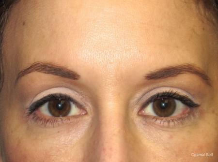 Eyelid Lift: Patient 1 - After  