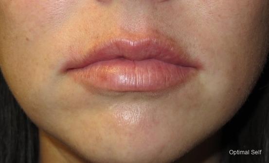 Juvederm: Patient 4 - After  