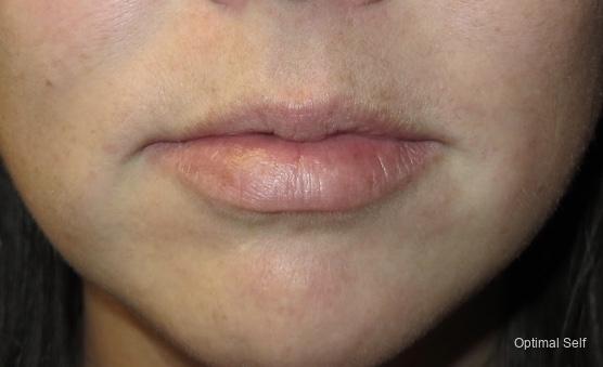 Juvederm: Patient 4 - After  