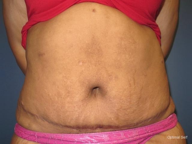 Tummy Tuck: Patient 1 - After  