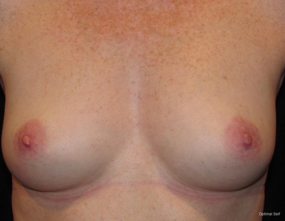 Breast Augmentation: Patient 11 - Before 