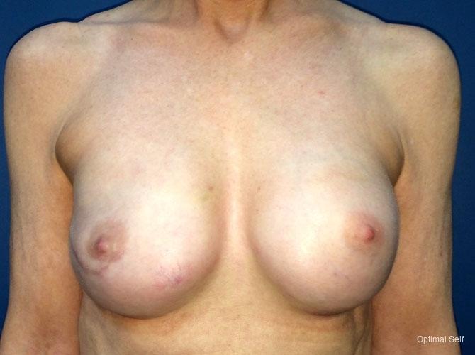 Breast Reconstruction: Patient 4 - After  