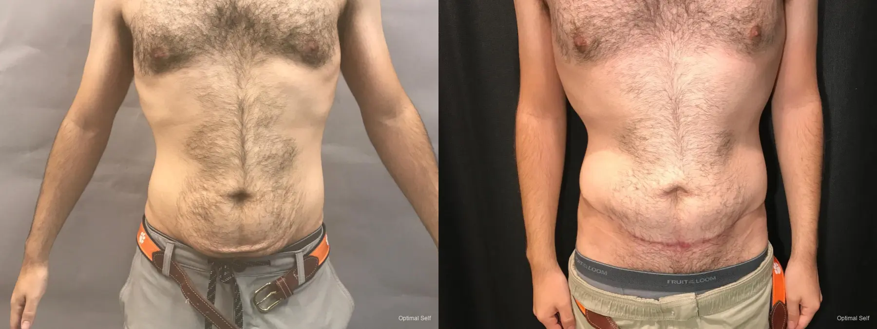 Abdominoplasty: Patient 8 - Before and After  