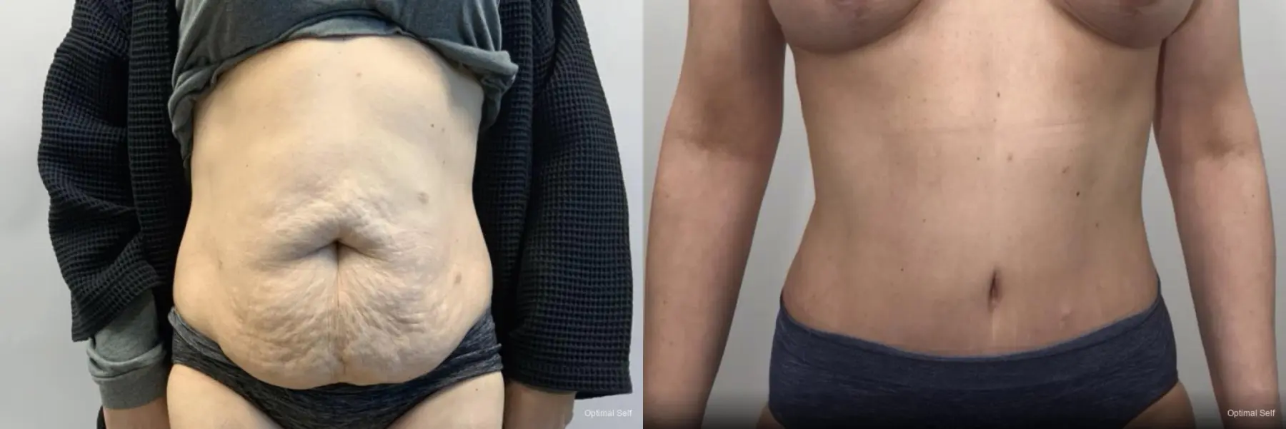 Abdominoplasty: Patient 3 - Before and After  