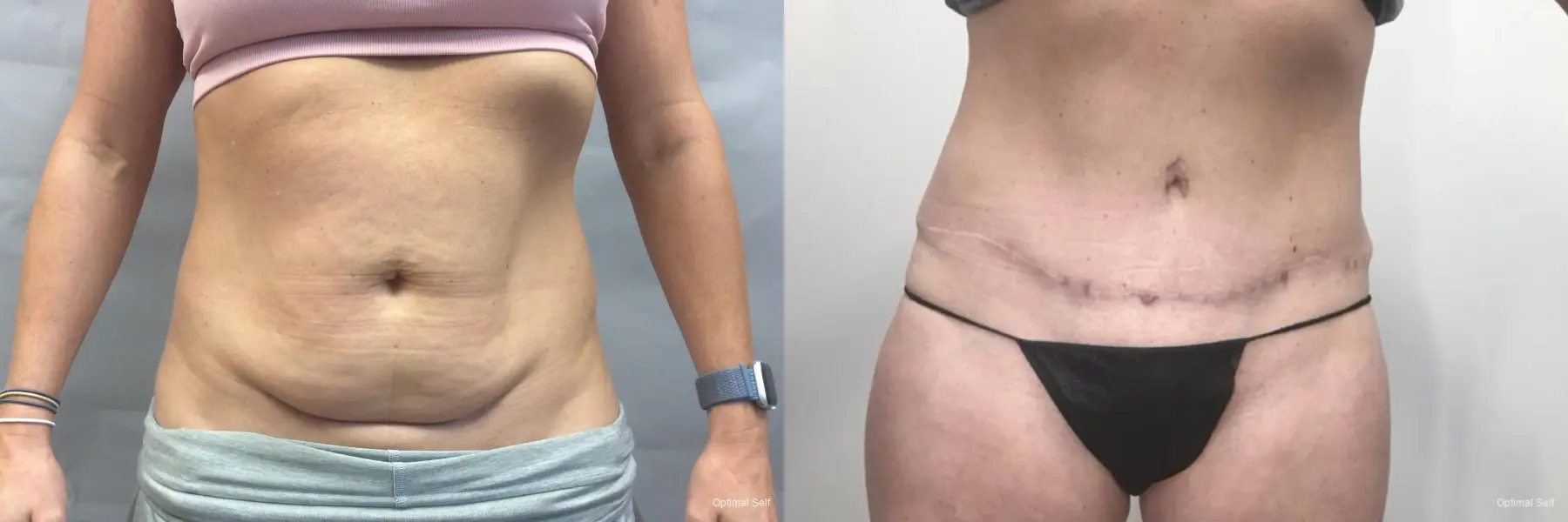 Abdominoplasty: Patient 7 - Before and After  