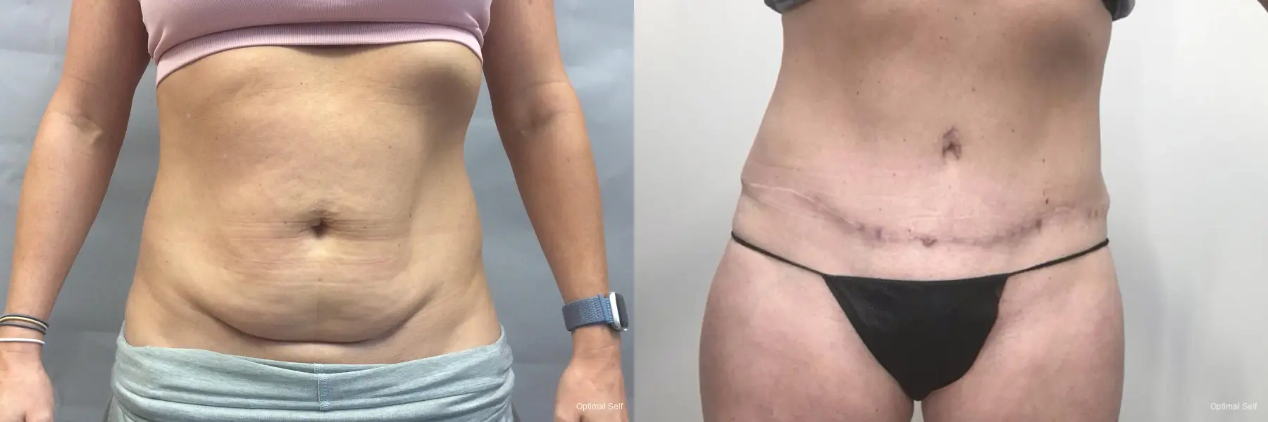 Abdominoplasty: Patient 6 - Before and After  