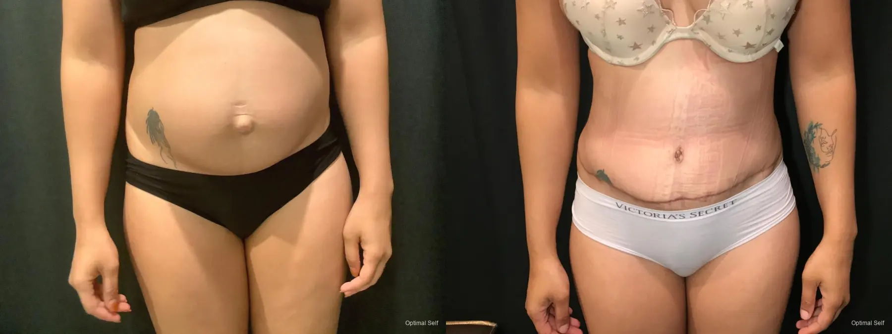 Abdominoplasty: Patient 9 - Before and After 1