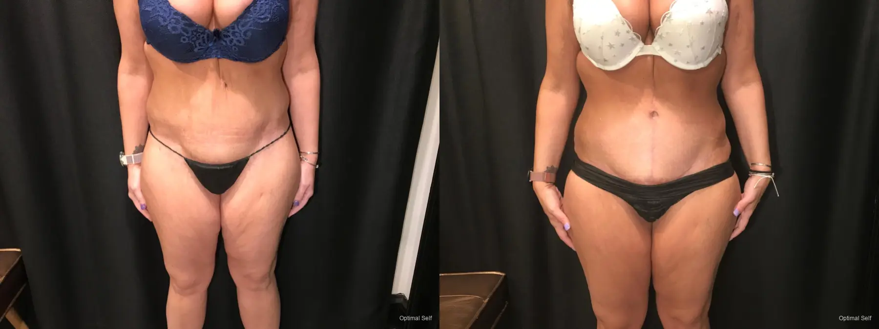 Abdominoplasty: Patient 12 - Before and After  