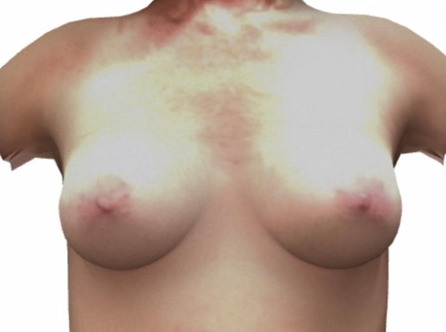 Breast Augmentation: Patient 9 - After  